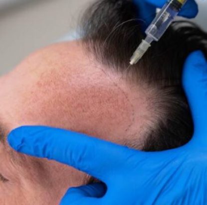 scalp micropigmentation